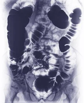 Barium enema study image or x-ray image of large intestine . Stock-Illustration