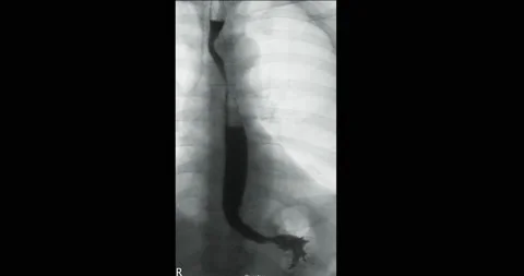 Barium Swallow Stock Footage 158319811