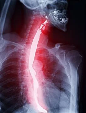 Barium Swallow study test diagnose Barrett's GI tract exam GERD ulcers seri.. Stock-Illustration