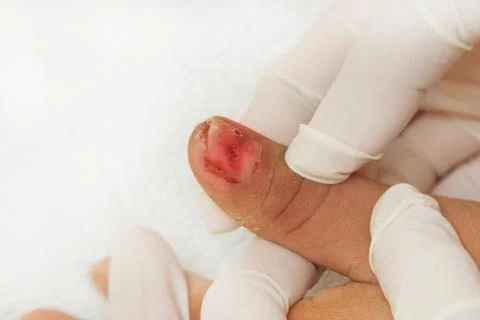 Base of the nail trauma Stock Photos