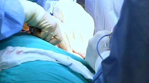 A basic surgical operation Stock Footage 220143825