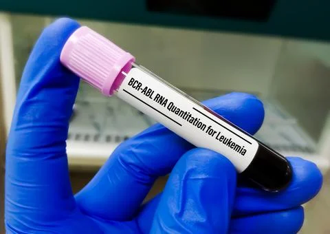 BCR-ABL RNA Quantitation test is used to diagnose chronic myeloid leukemia (CML) Foto stock