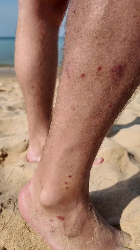 Beachside Bug Bite Woes Close Up Stock Footage 261166436