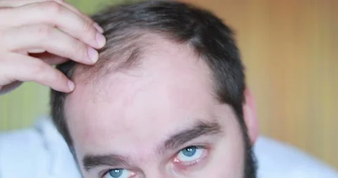 Bearded man standing in front of mirror and looking at his thinning hair, bald Stock Footage 95960247