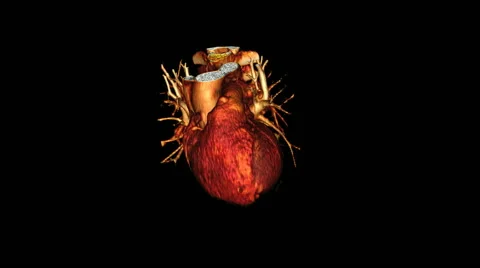 Ct Scan Heart Stock Footage ~ Royalty Free Stock Videos | Pond5