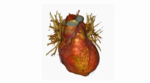 Heart Ct Scan Stock Footage ~ Royalty Free Stock Videos | Pond5