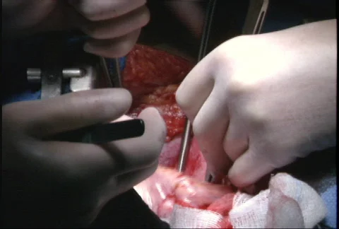 Beating heart during surgery Stock Footage 149612