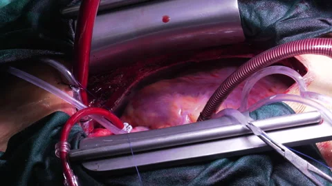 Beating heart in open-heart surgery Video stock 342798791