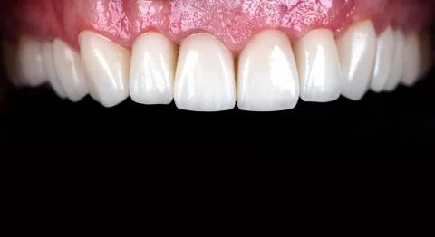 Beautiful  teeth  zircon  prothesis Implants crowns Dental whitening Stock Photos