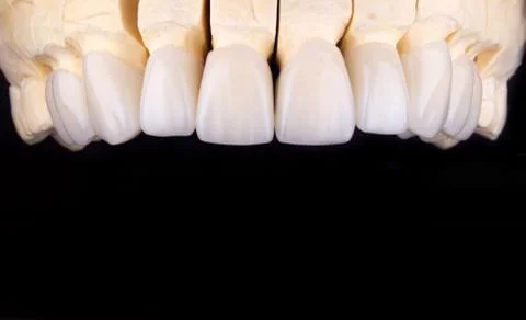 Beautiful  teeth  zircon  prothesis Implants crowns Dental whitening Stock Photos