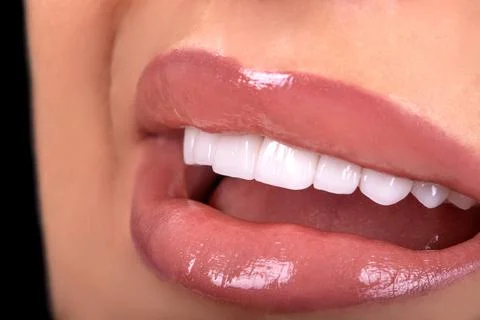 Beautiful  teeth  zircon  prothesis Implants crowns Dental whitening Stock Photos