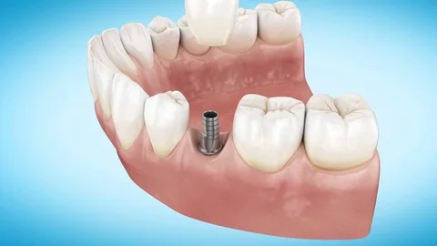 Beautiful Tooth implant installation process. Close Up 3d Animation. Stock Footage