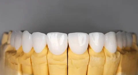 Beautiful upper teeth ceramic press veneers bleach of zircon arch prothesis I Stock Photos