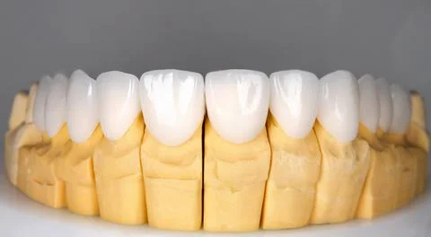 Beautiful upper teeth ceramic press veneers bleach of zircon arch prothesis I Stock Photos