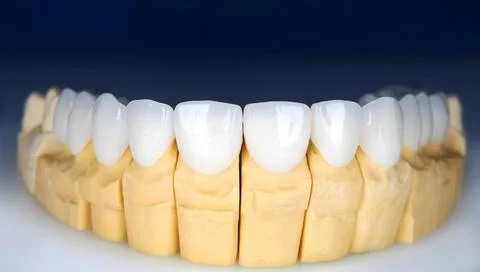 Beautiful upper teeth ceramic press veneers bleach of zircon arch prothesis I Stock Photos
