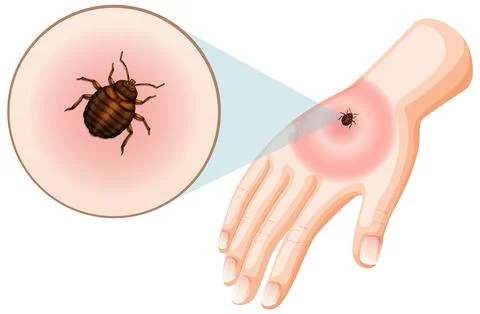 Bed bug bites sting on skin Stock Illustration