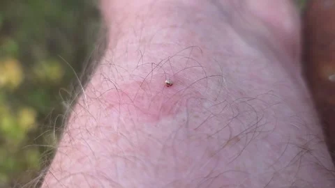 The bee left a sting with a vial of poison in the mans skin. Stock-Footage 345922385
