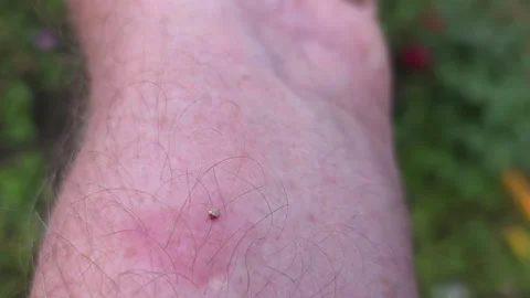 The bee left a sting with a vial of poison in the mans skin. Stock Footage 345922389
