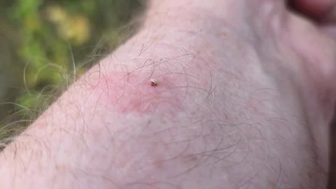 The bee left a sting with a vial of poison in the mans skin. Stock Footage 345922417