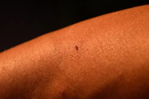Bee sting. Bee sting in human skin. consequences of stinging with bee venom. Stock Photos