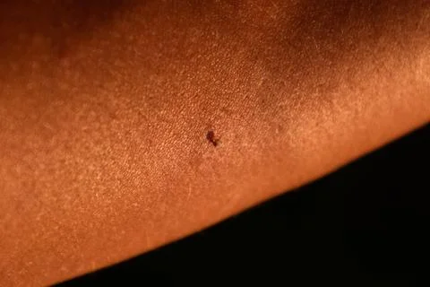Bee sting. Bee sting in human skin. consequences of stinging with bee venom. Stock Photos