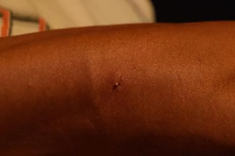 Bee sting. Bee sting in human skin. consequences of stinging with bee venom. Stock Photos