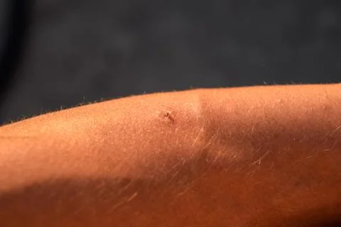 Bee sting. Bee sting in human skin. consequences of stinging with bee venom. Stock Photos