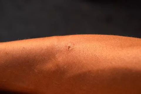 Bee sting. Bee sting in human skin. consequences of stinging with bee venom. Stock Photos
