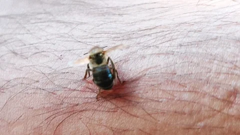 Bee sting in human skin Stock Footage 273110277