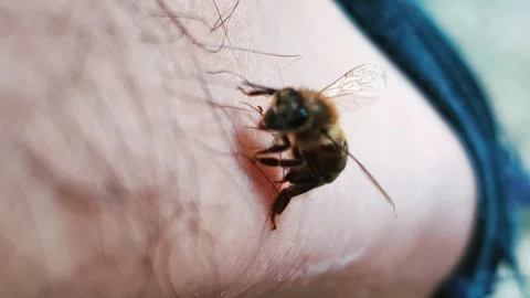 Bee sting in human skin Stock Footage 273110355