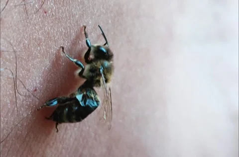 Bee sting in human skin Stock Footage 273110376