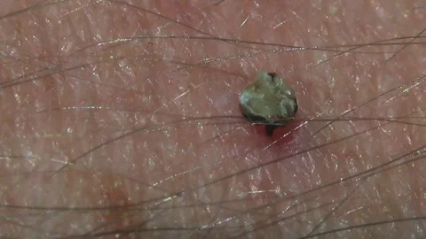 Bee's venom sac. Honey bee stings a man's arm. When the sting is over, the Video stock 256238024