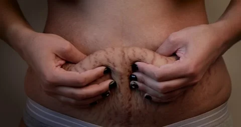 Belly skin with stretch marks after childbirth Stock Footage 136156809