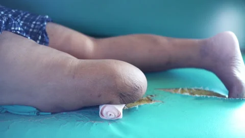 Below knee amputee patient exercise Video stock 148643161
