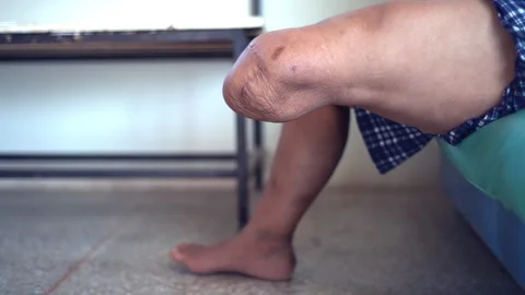 Below knee amputee patient exercise Video stock 148643197