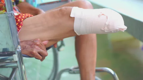 Below knee amputee patient exercise Stock Footage 148644371