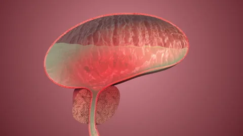 Benign Prostate Enlargement Impacting Urinary System Stock Footage 307091128