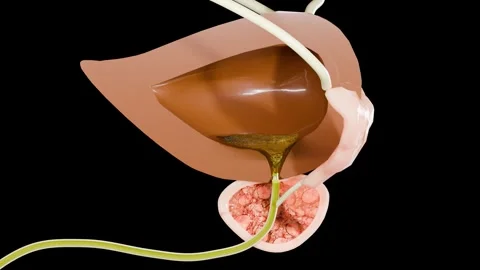 Benign prostatic, Enlargement and inflammation of the prostate, hyperplasia BPH Stockbeeldmateriaal 277521379