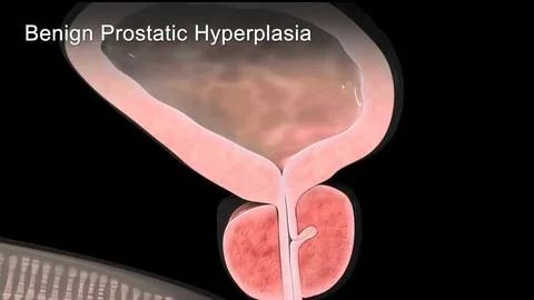 Benign Prostatic Hyperplasia 3d medical Stock Illustration