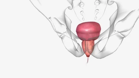Benign prostatic hyperplasia (BPH) is a non-cancerous condition in which the Stock Footage 246053611
