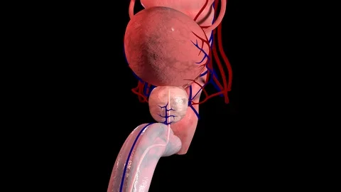 Benign Prostatic Hyperplasia Video stock 122501530