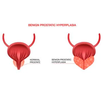Benign prostatic hyperplasia.Editable vector illustration in realistic style Stock Illustration
