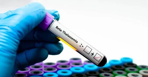 Beta-Thalassemia + Stock Photos
