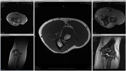 Bicep muscle tear Stock Footage 84512759