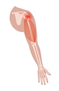 Biceps tear trauma Stock Illustration