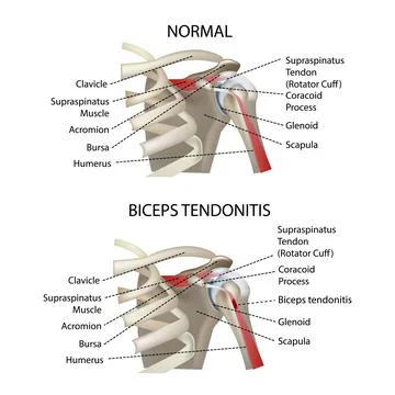 Biceps tendonitis, shoulder joint, realistic vector illustration Stock Illustration