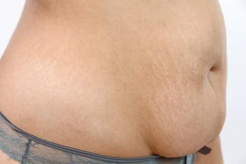 Big belly with stretch marks of a young overweighted woman . Stock Photos