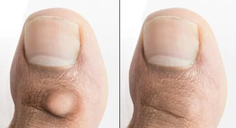 Big toe with and without corn before and after surgical removal Fotos de archivo