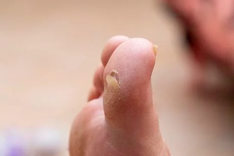 Big toe corn, foot callosity close up Fotos de archivo