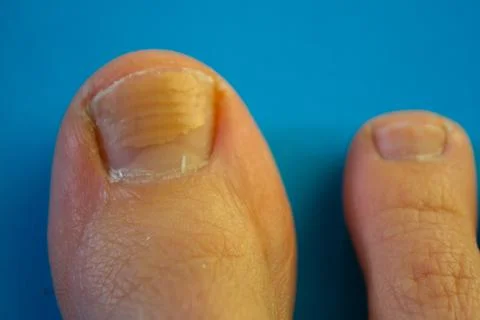 Big toe nail Stock Photos